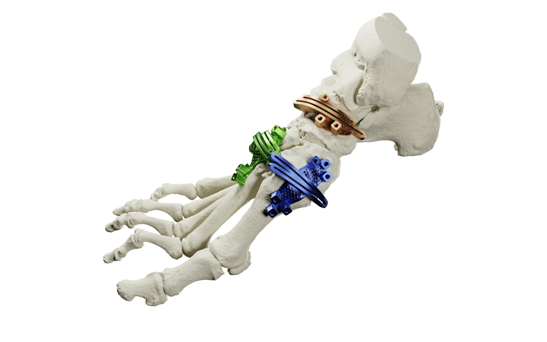 AccuStride® System 