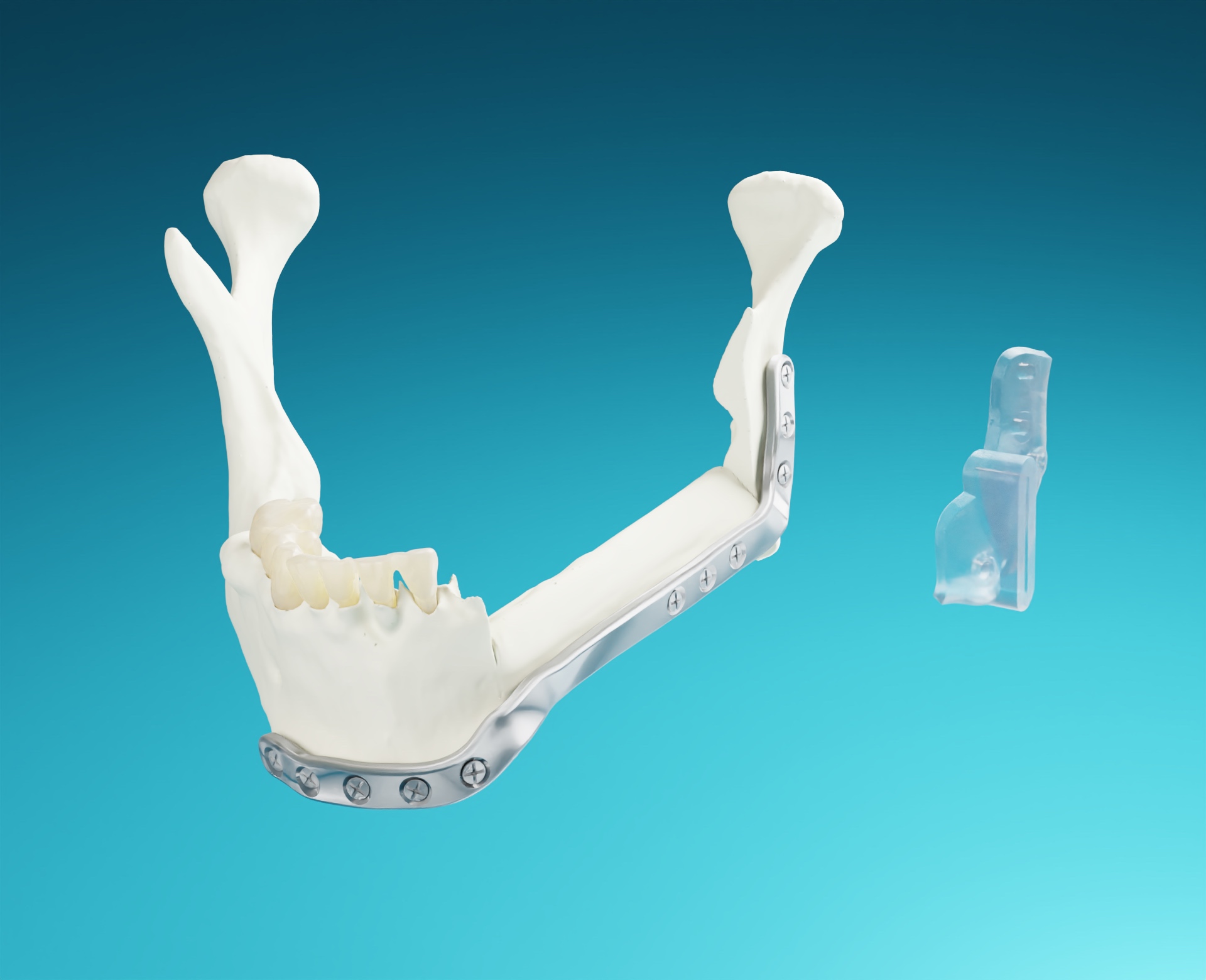 AccuPlan® & AccuPlate®