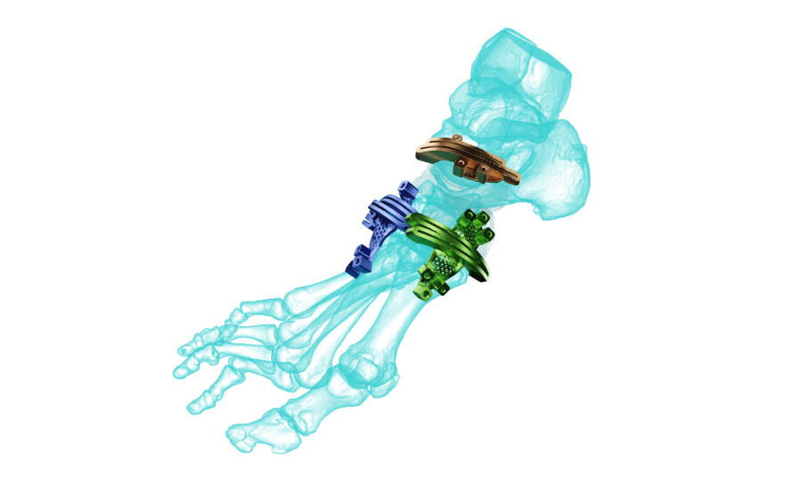 AccuStride® Foot + Ankle System