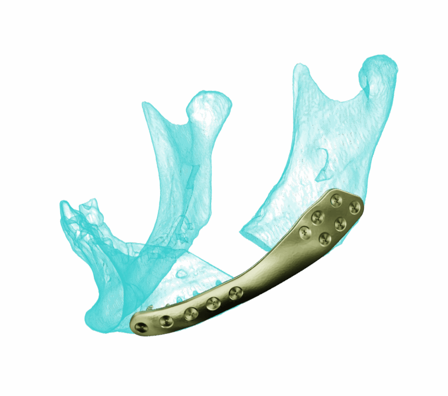 AccuPlan & AccuPlate