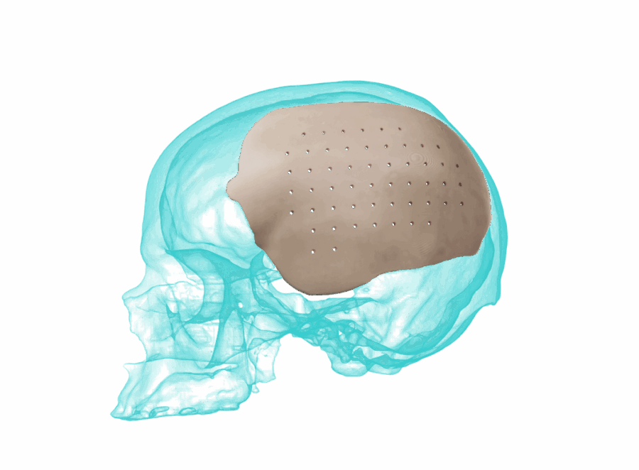 AccuShape PEEK & Titanium