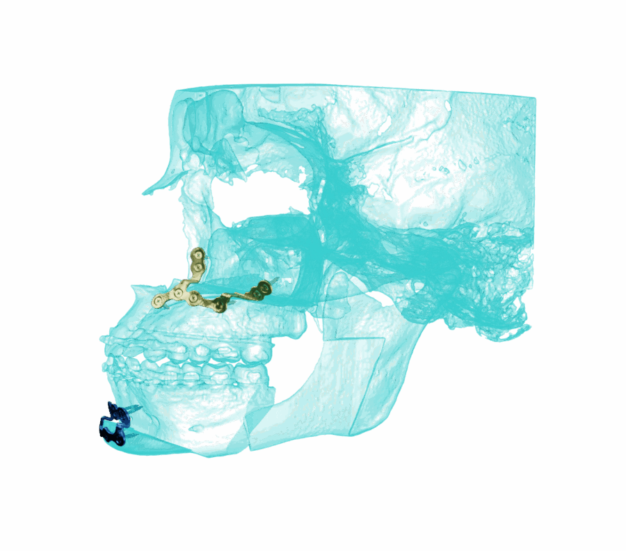 AccuPlan & AccuPlate